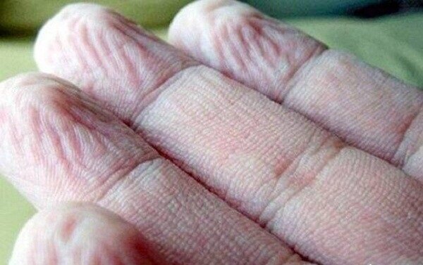 فواید شگفتانگیز چروکشدن انگشتان درون آب | این نوع چروک نشانه پارکینسون است