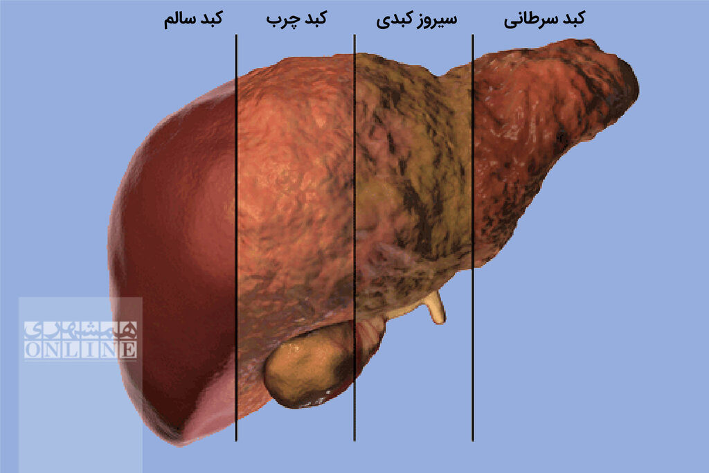 برای کبد چرب چی بخوریم و چی نخوریم؟