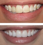 امروزه چه روش های زیبایی دندان وجود دارد؟