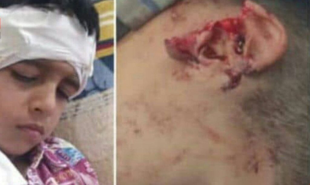 عکس | سگهای ولگرد گوش یک پسربچه را کندند!