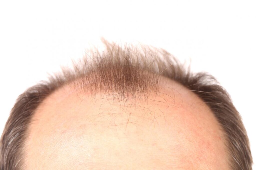 baldness
