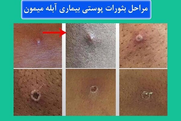 اگر این علائم را داشتید بدانید آبله میمونی گرفتهاید | این تغییرات پوستی را جدید بگیرید