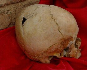 جمجمه سوراخ شده دختر ۱۳ ساله در امیرآباد