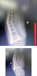 ماجرای عجیب جراحی‌های یک بیمارستان در نیشابور | پلاتین‌هایی که در پای بیماران خم می‌شود | عکس رادیولوژی را ببینید