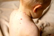 مواظب باشید تب «گوجه فرنگی» نگیرید | این بیماری نه آنفلوآنزا است و نه ربطی به گوجه فرنگی دارد | ویروس جدید فقط کودکان را مبتلا می‌کند؟