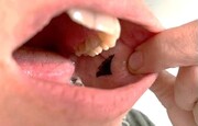 انسولینی که می‌توانید به جای تزریق در دهان بگذارید