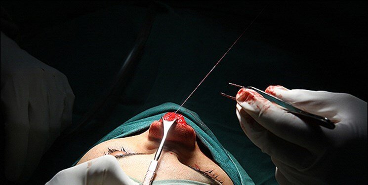 جراحی زیبایی ـ عمل بینی
