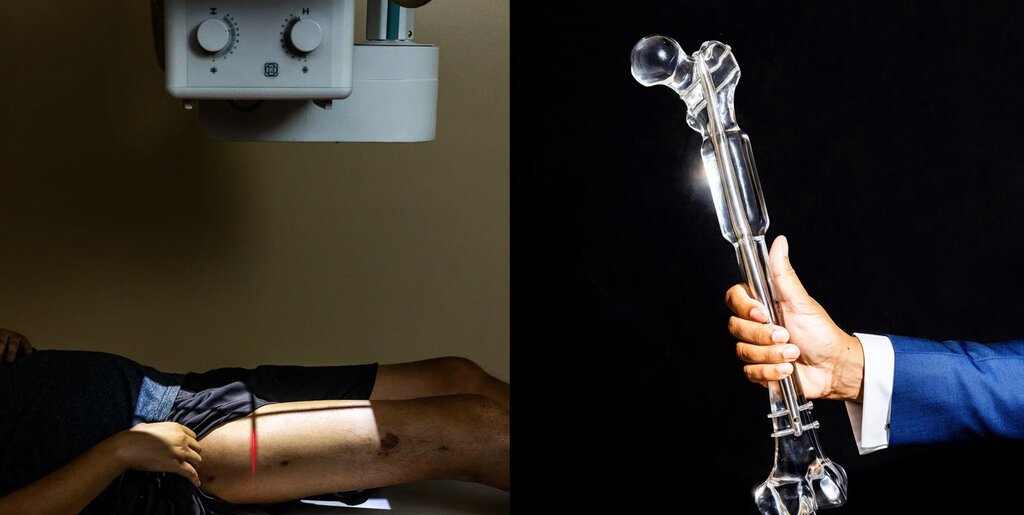 مهندسان شرکتهای تکنولوژی آمریکا برای بلندتر شدن قدشان به جراحیهای پرخرج تن در میدهند