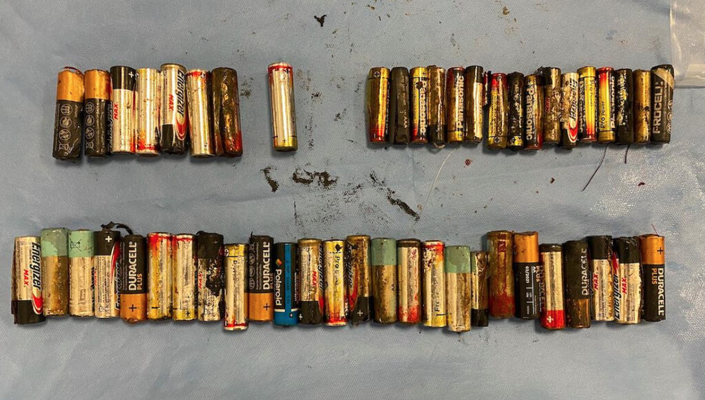 پزشکان ۵۰ باتری قلمی و نیم‌قلمی را از روده و معده یک زن خارج کردند