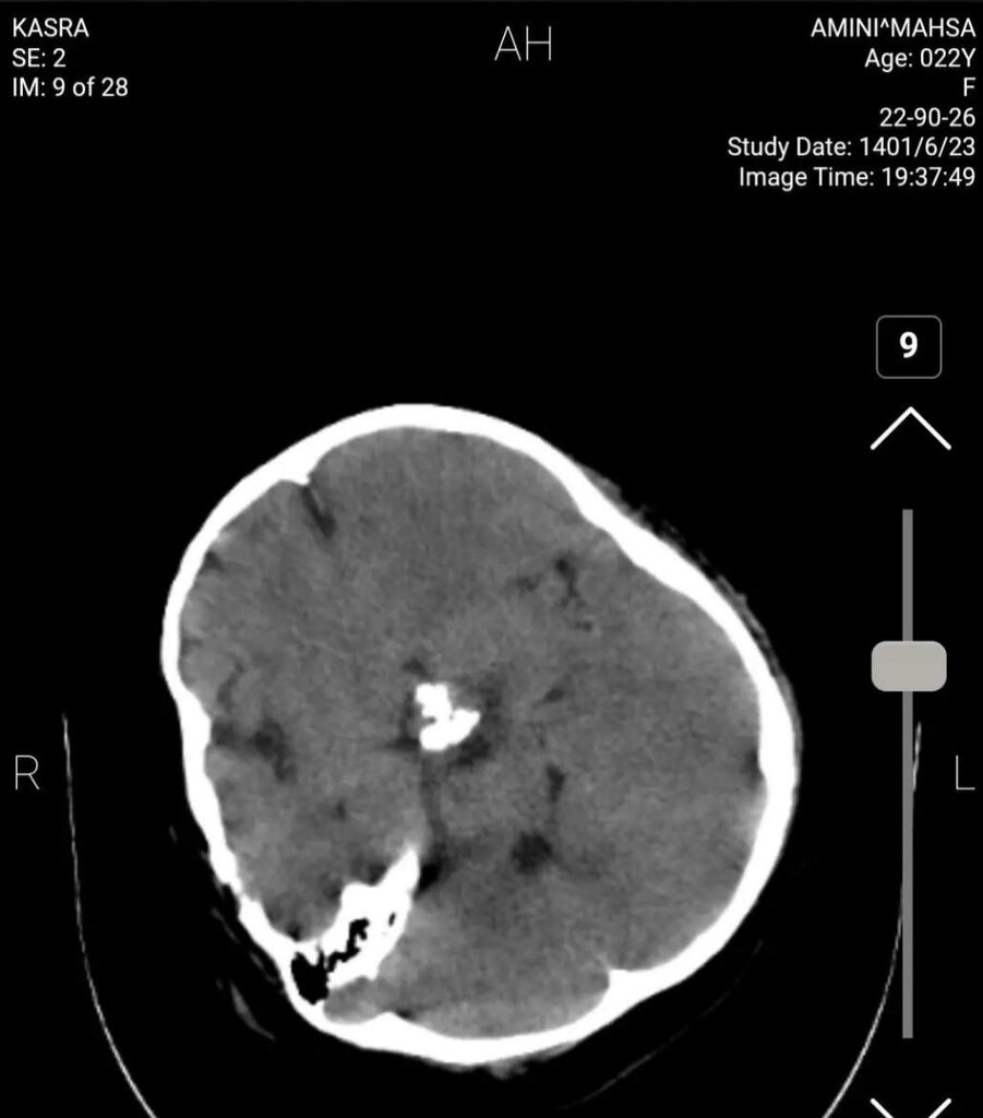 تصویر سیتی اسکن مهسا امینی در اینترنشنال تایید شد! | توضیحات مهم دو متخصص مغز و اعصاب