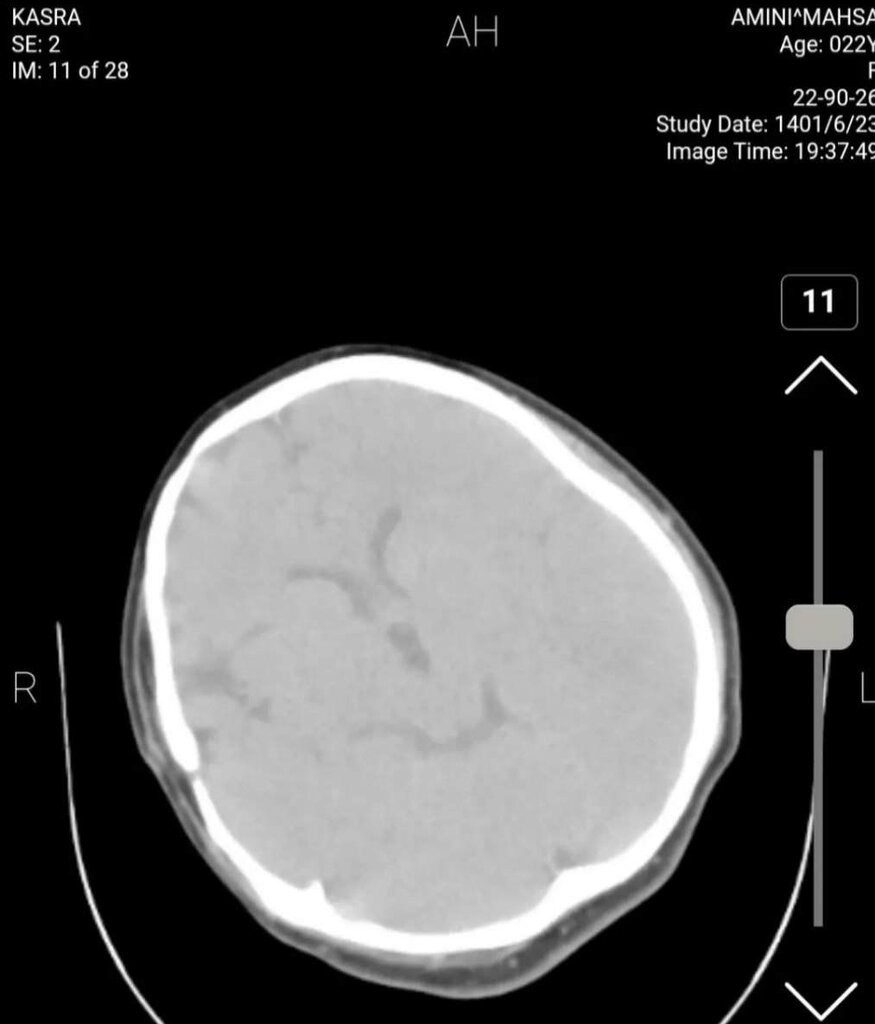 تصویر سیتی اسکن مهسا امینی در اینترنشنال تایید شد! | توضیحات مهم دو متخصص مغز و اعصاب