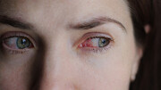 لنزهای تماسی چندبار مصرف احتمال یک عفونت نابیناکننده را افزایش می‌دهند|| خطر لنز داشتن در زیر دوش