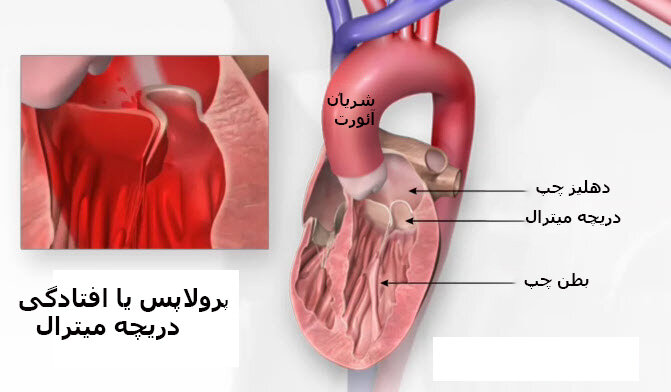 پرولاپس دریچه میترال قلب