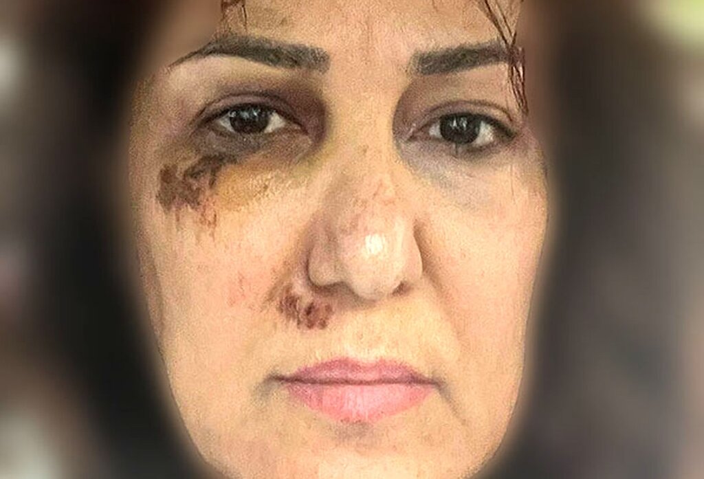 روایتی از هرینه های اقدام معنادار پانته‌آ بهرام؛ هدف او از انتشار تصویر بی حجاب با صورت کبود چه بود؟ |  تصویر او را ببینید