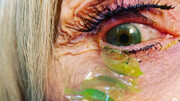 تصاویر | انبار شدن لنز رنگی در چشم یک زن! | خارج کردن ۲۳ لنز تماسی از چشم با پنس جواهرسازی