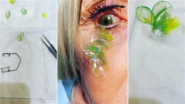 تصاویر | انبار کردن لنز رنگی در چشم یک زن! | خارج کردن ۲۳ لنز تماسی از چشم با پنس جواهرسازی