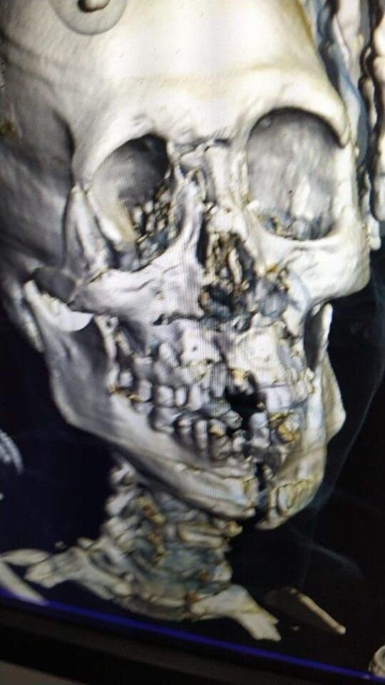 تصاویر| تلخ ترین اتفاق جام جهانی؛جمجمه بازیکن عربستان از وسط نصف شد! | بن سلمان جت شخصی اش را برای انتقال فرستاد