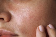 آیا استفاده از ژل شستشو در درمان جوش صورت موثر است؟