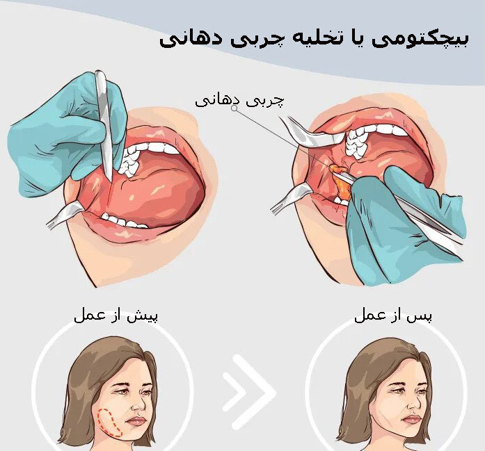 گرایش به داشتن چهره زاویهدار | هشدار پزشکان درباره رعایت احتیاط درباره یک ترند جراحی پلاستیک