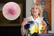 جراحی همسر رئیس‌جمهور آمریکا برای یک نوع شایع سرطان پوست