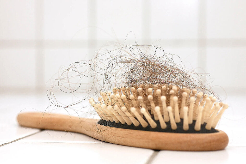 ریزش مو - hair loss - ریزش مو در مردها
