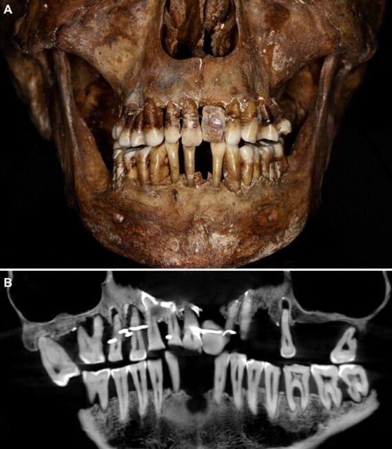روش عجیب نگه داشتن دندان‌ها توسط این زن ثروتمند فرانسوی قرن هفدهمی! | رنج‌هایی که آن دالگر در زندگی کشید