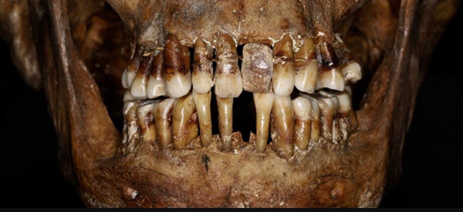 دندان‌های مومیایی