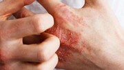 انواع حساسیت پوستی را بشناسید؛ از حساسیت به موبایل و رژ لب تا کهیر | علائم بیماری‌های مرتبط با این حساسیت‌ها چیست؟