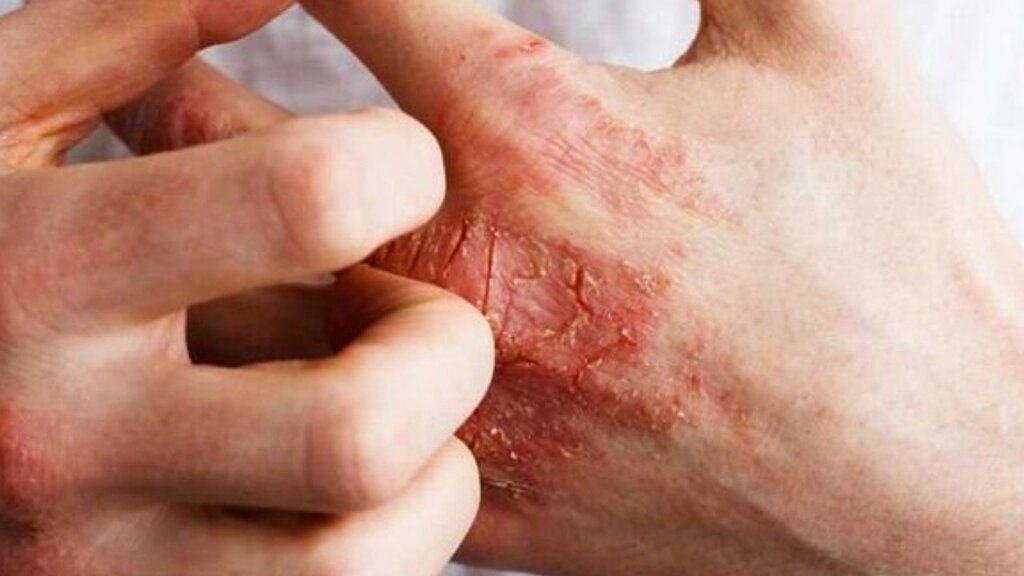 حساسیت پوستی - آلرژی