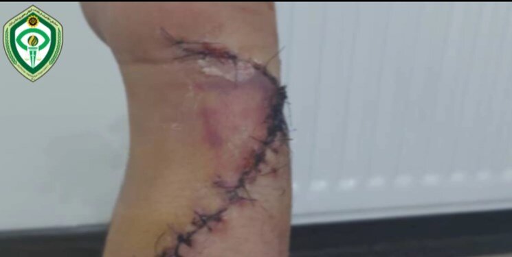 تصاویر (۱۶+) | حمله خونین اراذل در بریانک؛ نقص عضو یک شهروند | دستی که پزشکان پیوند زدند