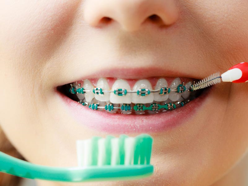 چه کسانی نیاز به ارتودنسی دندان دارند؟