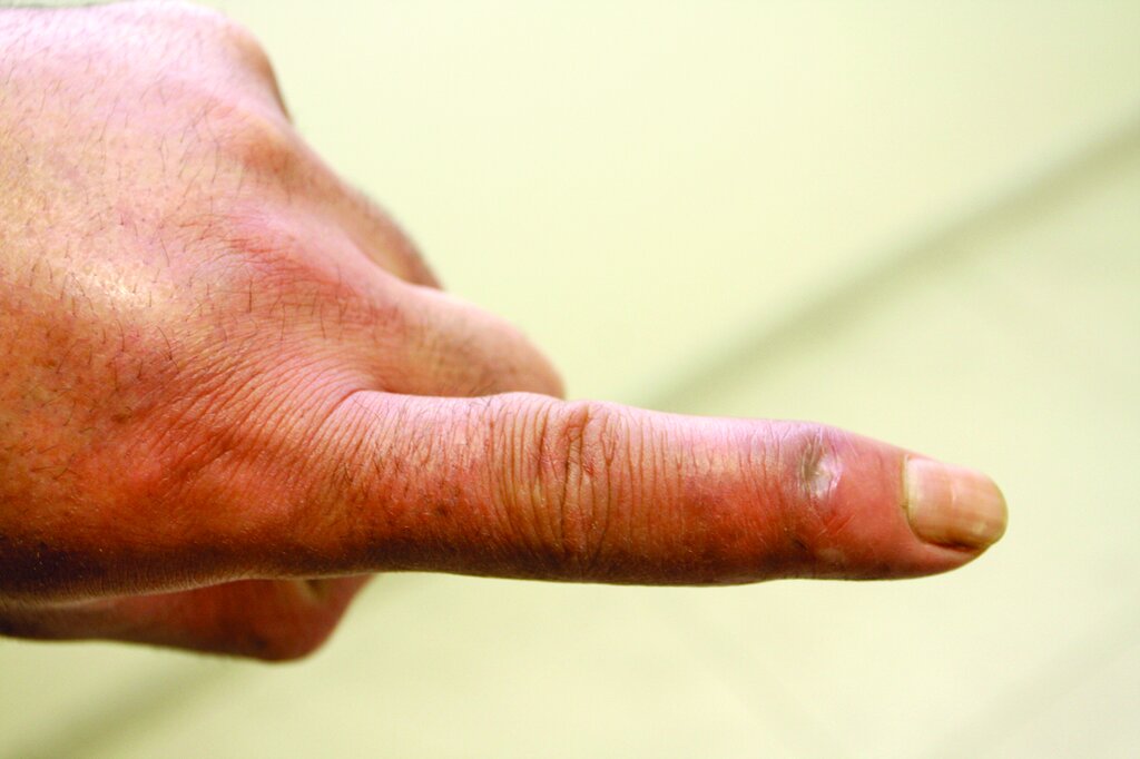 اقدامات اولیه در برخورد با عقرب گزیدگی