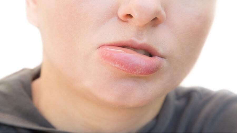 آیا ورم لب خطرناک است؟ دلایل و راههای درمان آن را بشناسید