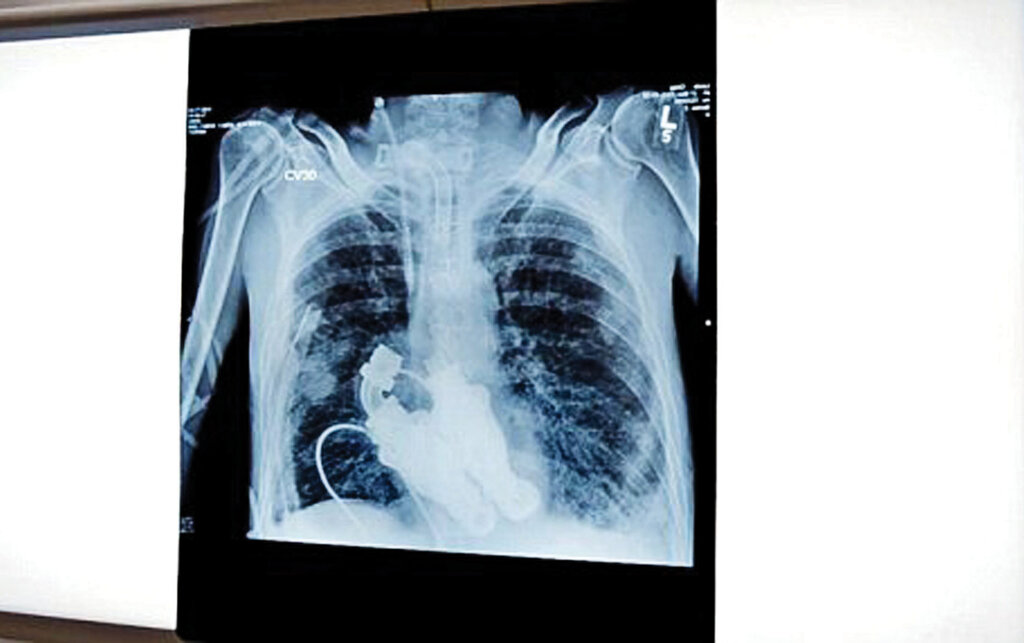 تنها انسان زنده بدون قلب دنیا ؛ مردی که قلب نداشت