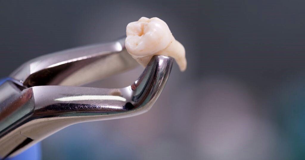 بهترین راه جلوگیری از پوسیدگی و خرابی دندان‌ها | هر ایرانی حداقل ۶ دندان پوسیده دارد | مردم این کشورها یک دندان پوسیده هم ندارند