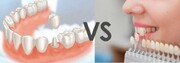 تفاوت روکش دندان با لمینت و کامپوزیت دندان در چیست؟
