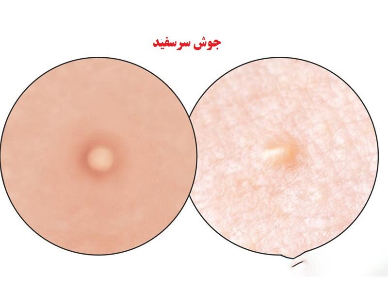 انواع جوش صورت و روش های درمان آن