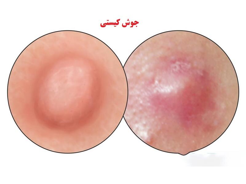 انواع جوش صورت و روش های درمان آن