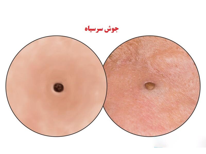 انواع جوش صورت و روش های درمان آن