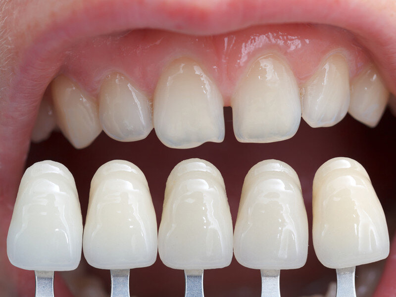 تفاوت روکش دندان با لمینت و کامپوزیت دندان در چیست؟