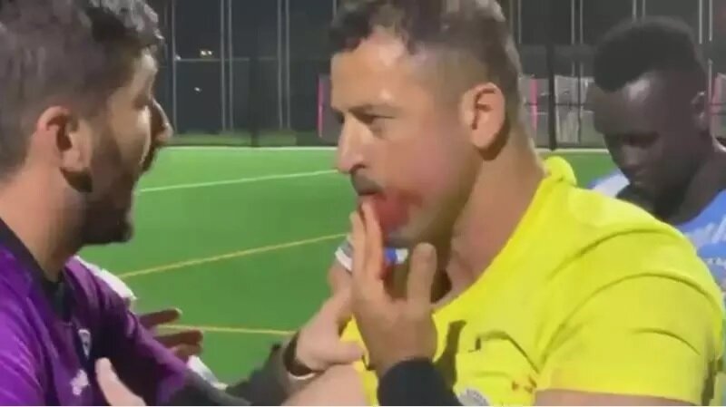 تصاویر | فک و دندان‌های خرد شده داور زیر مشت‌ فوتبالیست بوکسور! | ضربات دیوانه‌وار بازیکن خشمگین به قصد کشت!
