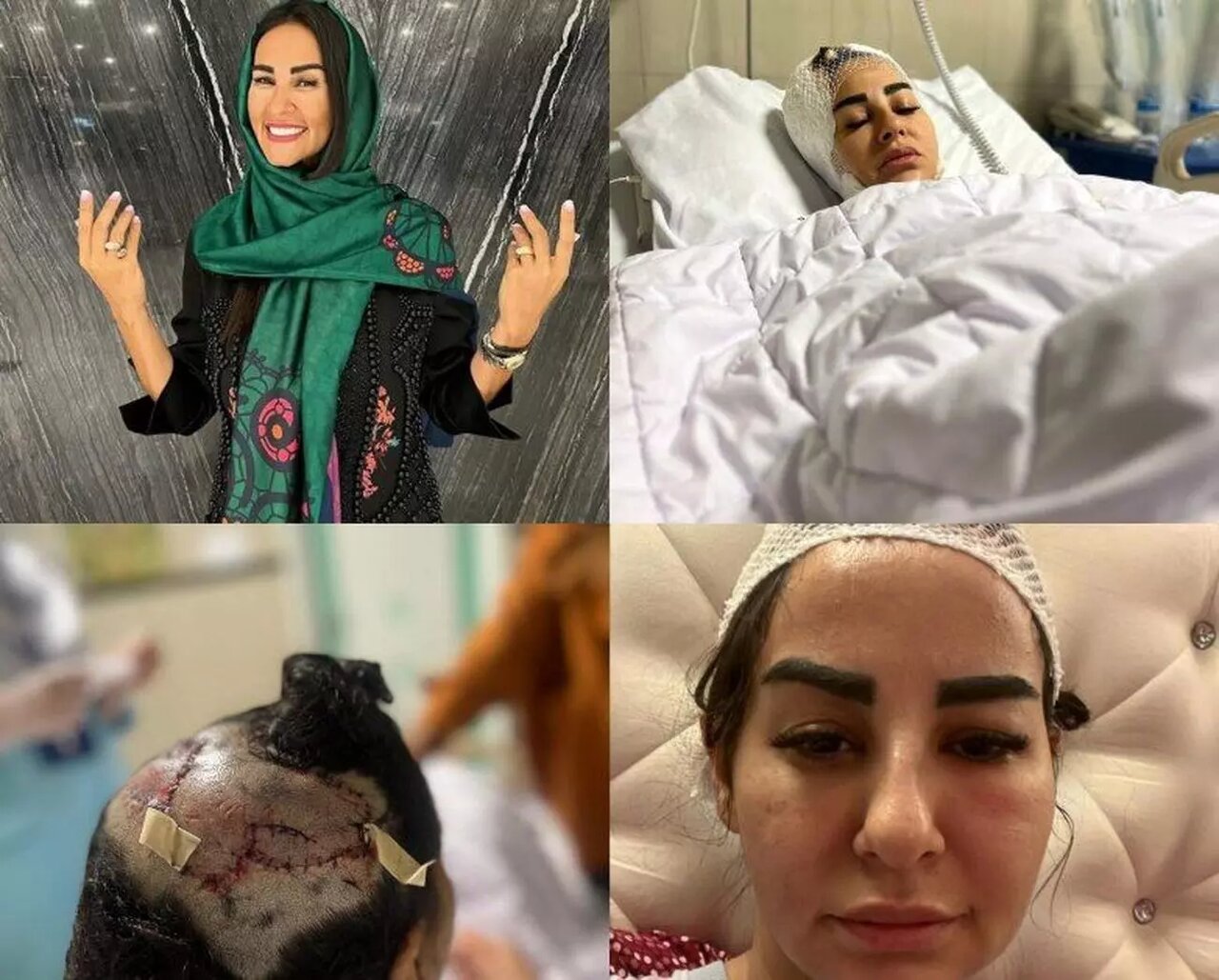 تصاویر زن جوان پس از حمله هولناک سـگ لاکچری | سرم جراحی شد و بدنم ۱۱۰ بخیه خورد | صاحب پیت بول هیچ دلجویی و عیادتی از من نکرد