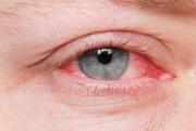 یک سویه جدید کروناویروس علائمی از جمله قرمزی چشم دارد که شبیه به آلرژی است
