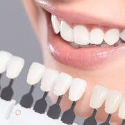 نوع کامپوزیت چه نقشی در زیبایی لبخند شما دارد؟ | عوامل مؤثر در داشتن دندان‌های درخشان