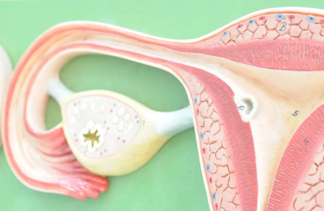 درمان کیستهای تخمدان با تغییر در رژیم غذایی | کاهش احتمال موفقیت در بارداری افراد دارای اضافه وزن و مبتلا به سندروم تخمدان پلی کیستیک