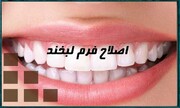 لمینت دندان یا کامپوزیت دندان؟ کدام روش اصلاح طرح لبخند را انتخاب کنیم؟