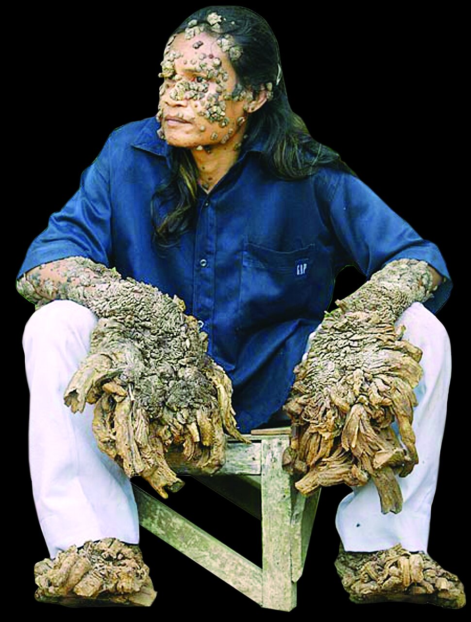 این درخت حرف میزند | تصاویر باور نکردنی از مردی که شبیه درخت شد | او نصفش انسان و نصف دیگرش درخت بود