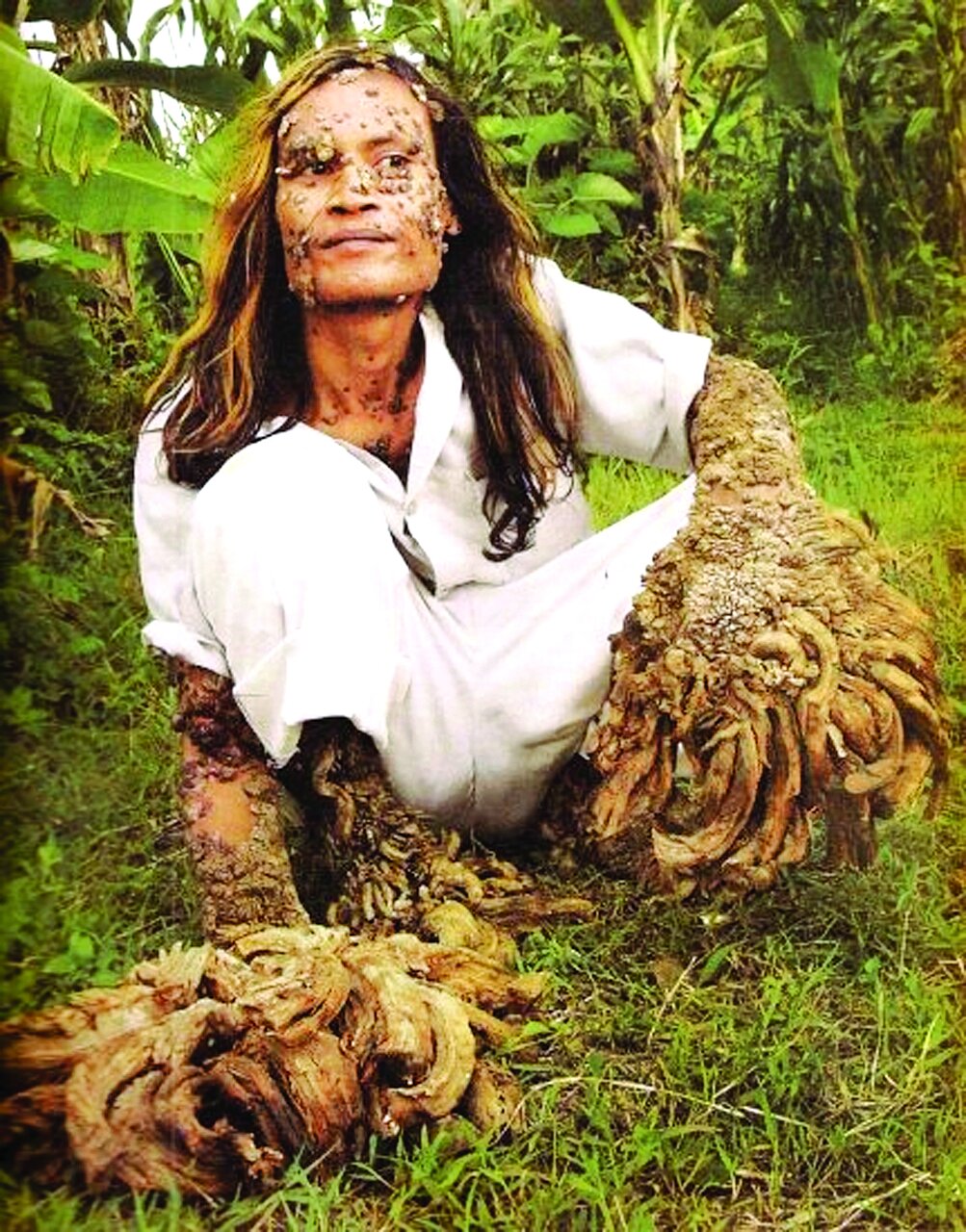 این درخت حرف می‌زند | تصاویر باور نکردنی از مردی که شبیه درخت شد | او نصفش انسان و نصف دیگرش درخت بود