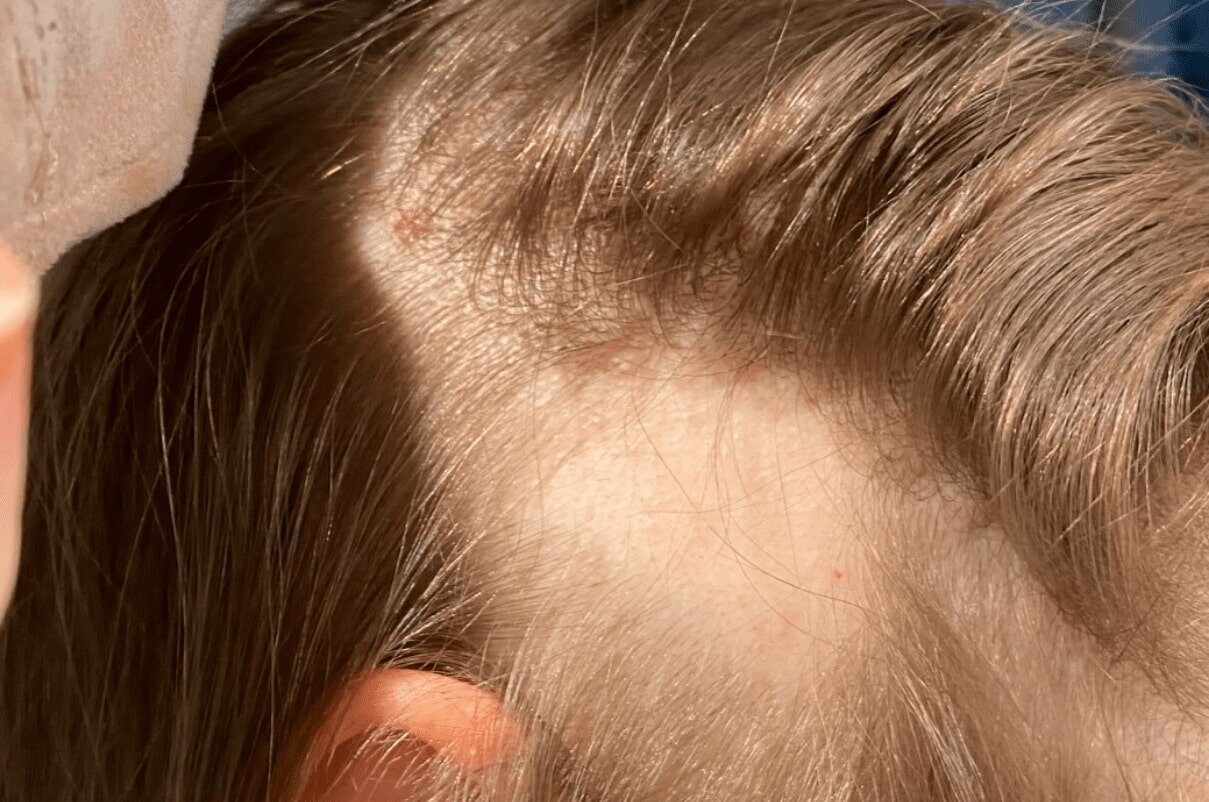 Alopecia