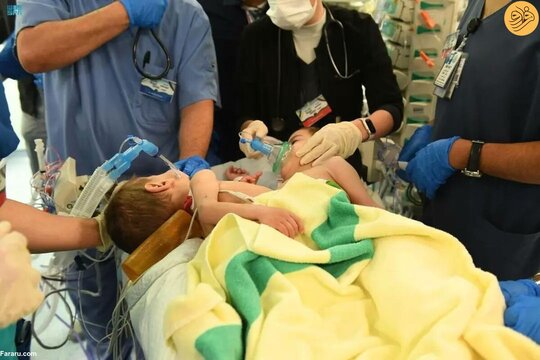 جداسازی دوقلوهای بههم چسبیده